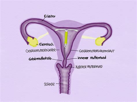 Comment fonctionne le stérilet hormonal DIU cyclotest