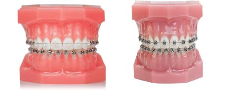 Les Appareils Multi Attaches Orthodontie Chelles