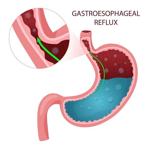 Gastroesophageal Reflux Disease Diagram 17214598 Vector Art At Vecteezy