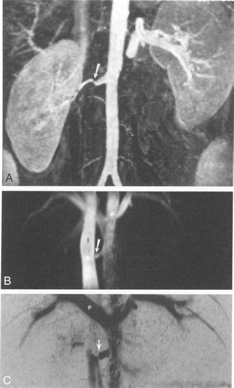 A 26 Year Old Woman With A History Of Left Nephrectomy And Suspicion Of