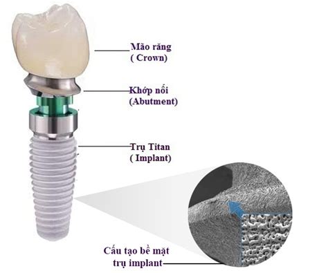 T M Hi U V Ph Ng Ph P Vi C Tr Ng R Ng B Ng C Y Gh P Implant