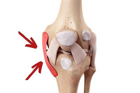 ¿Cuánto dura un esguince de rodilla? | JL FISIOS