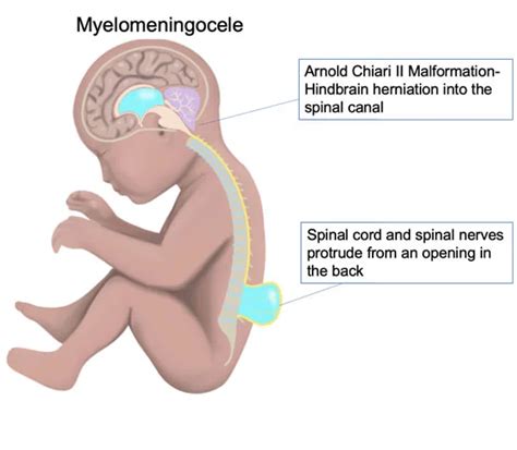 Spina Bifida Cause Symptoms Diagnosis Treatment