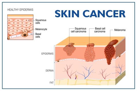 Skin Cancer Types Diagnosis Prevention Risk Factors