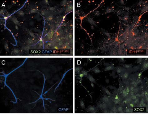 Co Expression Of Glial And Stemness Markers In Idh R H Positive