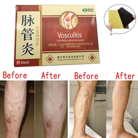 Buy 24 Pcs Spider Veins Varicose Treatment Plaster