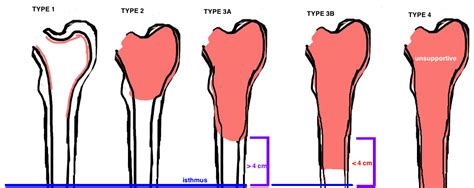 Osteolysis And Aseptic Loosening — Hip And Knee Book