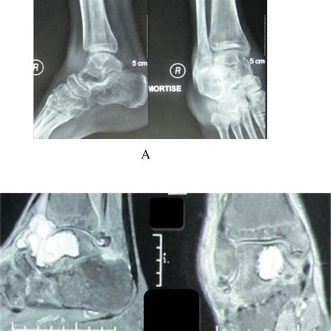 Radiological Examinations A Plain Radiograph Of The Talus Showed A Download Scientific