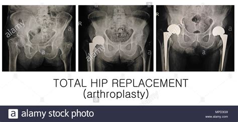 Total Hip Replacement Stock Photos And Total Hip Replacement Stock Images