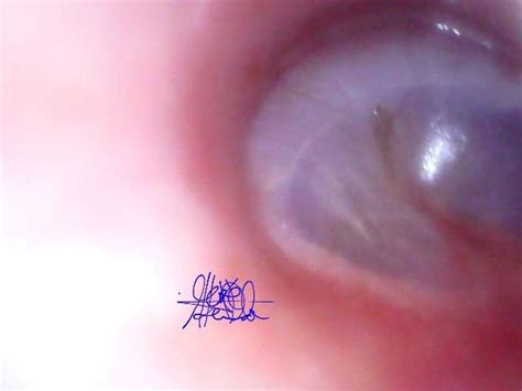 Normal Ear Drum by Camera Otoscopy - Niugini Medical & Diagnostic Services