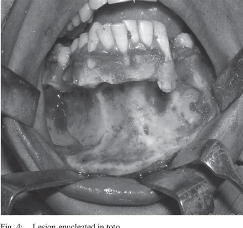 Figure From Conservative Management Of Keratocystic Odontogenic