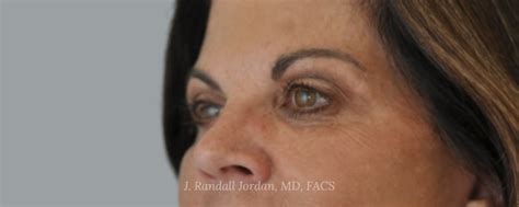 Brow Lift Case 6023 Faces PLLC In Ridgeland MS