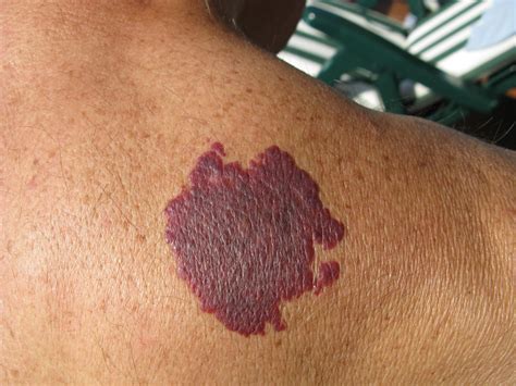 When to Consider Birthmark Removal - Forefront Dermatology