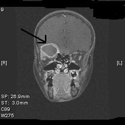 Fibrous Dysplasia MRI Sumer S Radiology Blog