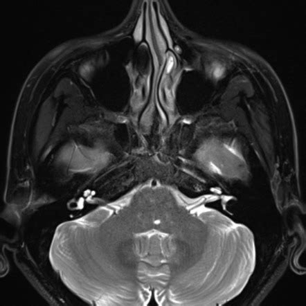 Abducens Nerve