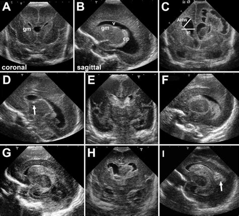 Neonatal Posthemorrhagic Hydrocephalus From Prematurity