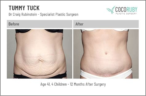 Will Insurance Cover Tummy Tuck After Lap Band Marisol Sharkey