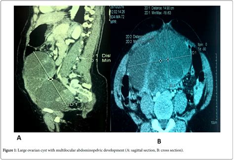 Gynecology Multilocular Abdominopelvic