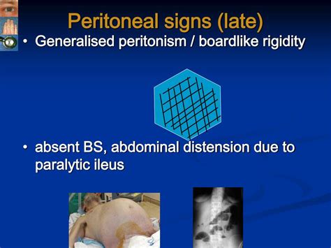 Peritoneal Signs