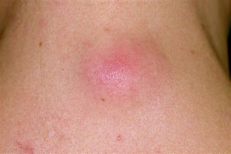 Infected Sebaceous Cyst Photograph By Dr P Marazzi Science Photo Library