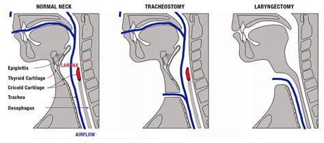 Laryngectomy