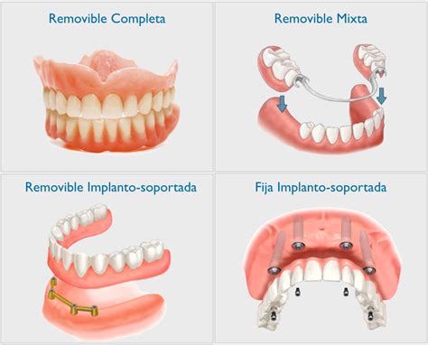 Conozca Los Diferentes Tipos De Protesis Clinica Dental Canalejo