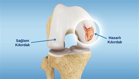K K Rdak Onar M Nda Osteokondral Allogreft Nakli Tedavisi Kayhan