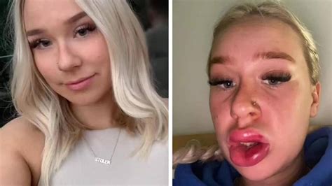 Ladbible News On Twitter 🔔 Woman Shows How Her Lip Fillers Went Badly Wrong And People Are