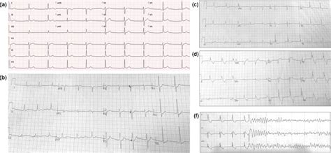 A Normal Baseline Electrocardiogram B C D Temporal Progression Of Download Scientific