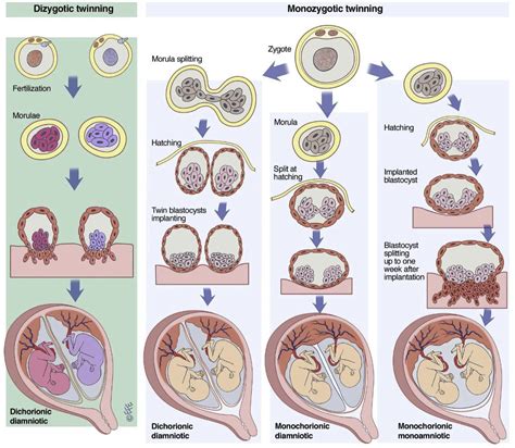 TRA Types Of Twinning Image | Midwifery, Multiple pregnancies, Medical ...