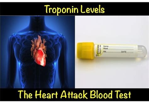 Troponin Levels Chart A Visual Reference Of Charts Chart Master