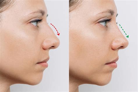 Rinoplastia Correctora Mejora Tu Salud Y Est Tica Nasal Con Este