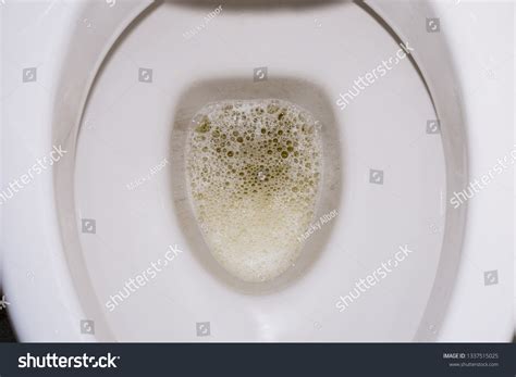 Frothy Bubbly Urine Toilet Bowl Kidney Stock Photo 1337515025 | Shutterstock