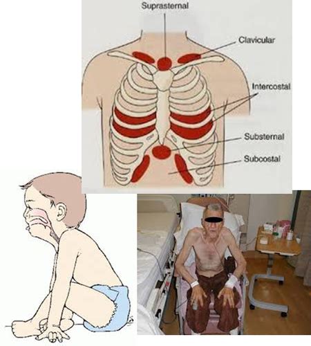 PE - Advanced Pulmonary Exam - Lec. 14 - Farrish - Cura Personalis ...