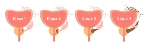 ¿qué Es El Cáncer De Próstata Cuan Hospital