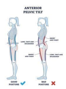 Why Are My Hips So Tight Understanding Anterior Pelvic Tilt