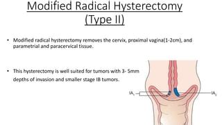 Surgical Management Of Carcinoma Cervix PPT