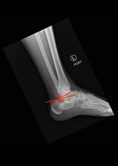 Left Calcaneal Fracture Xr Annotated Bohlers Angle Jetem 2017 Jetem