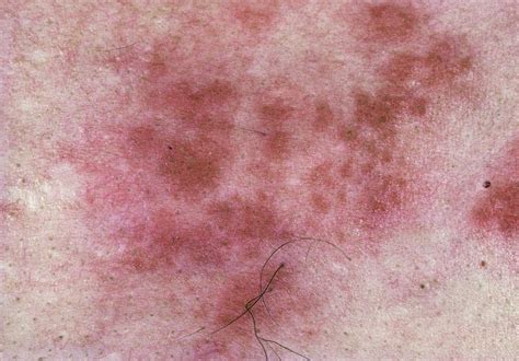 Shingles Rash From Herpes Zoster Infection Photograph by James ...