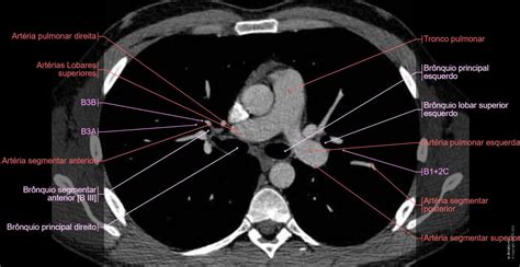 Anatomia Dos Pulmões Mediastino E Coração Em Tac Tomografia Torácica