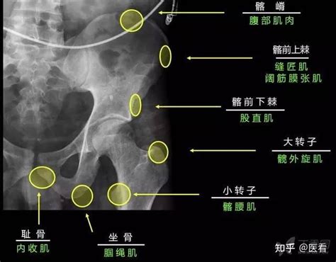 这36种骨折，影像医生值夜班时千万不要漏诊！ 知乎