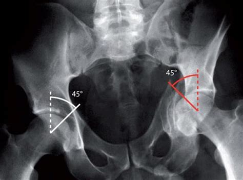 Roof Angle Acetabular - 12.300 About Roof