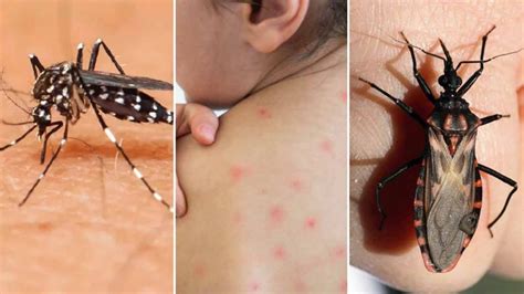 D A Mundial De La Enfermedad De Chagas S Ntomas Y Causas