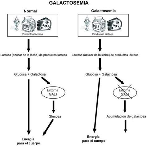 Galactosemia Variante Duarte Newbornscreening Info