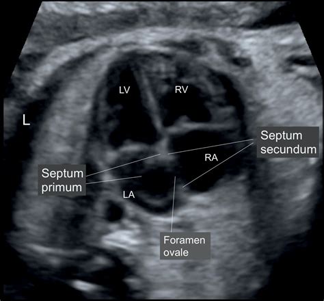 Cardiac Chambers: The Four-Chamber and Short-Axis Views | Obgyn Key