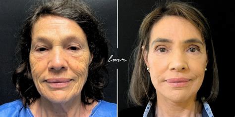 Blefaroplastia Enxerto De Gordura No Rosto Lifting Facial Peeling