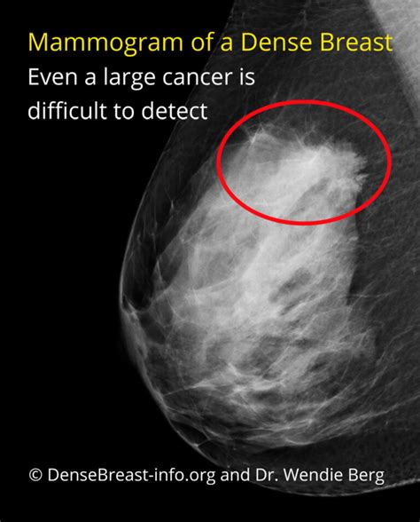 Mammogram Vs Thermogram Vs Other Thermography Advantage