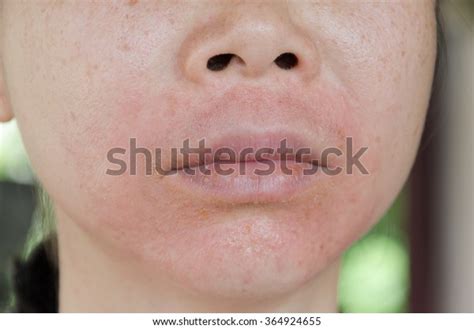 Human Skin Presenting Allergic Reaction Allergic Stock Photo