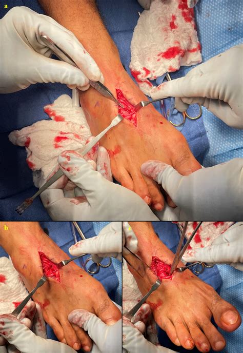 A Rare Case Of A Lisfranc Ligament Transection Published In