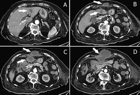 Liver Abscess Ct Scan